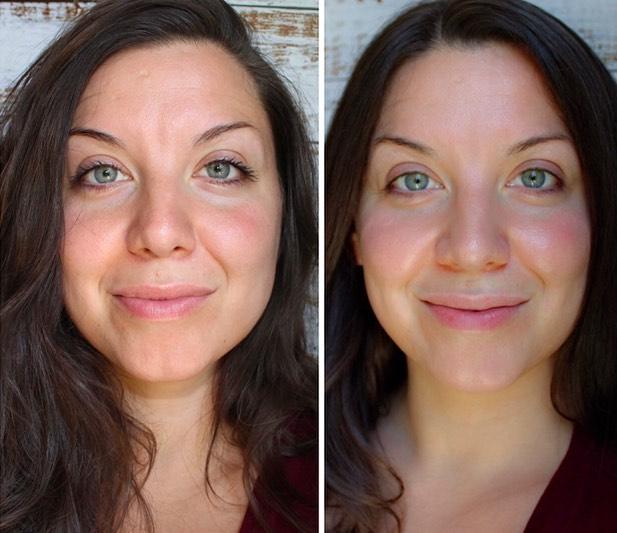 Hydra Facial