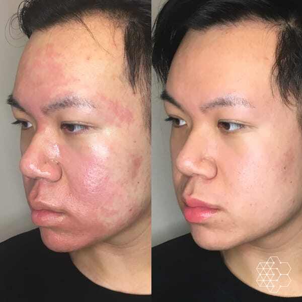 Hydra Facial