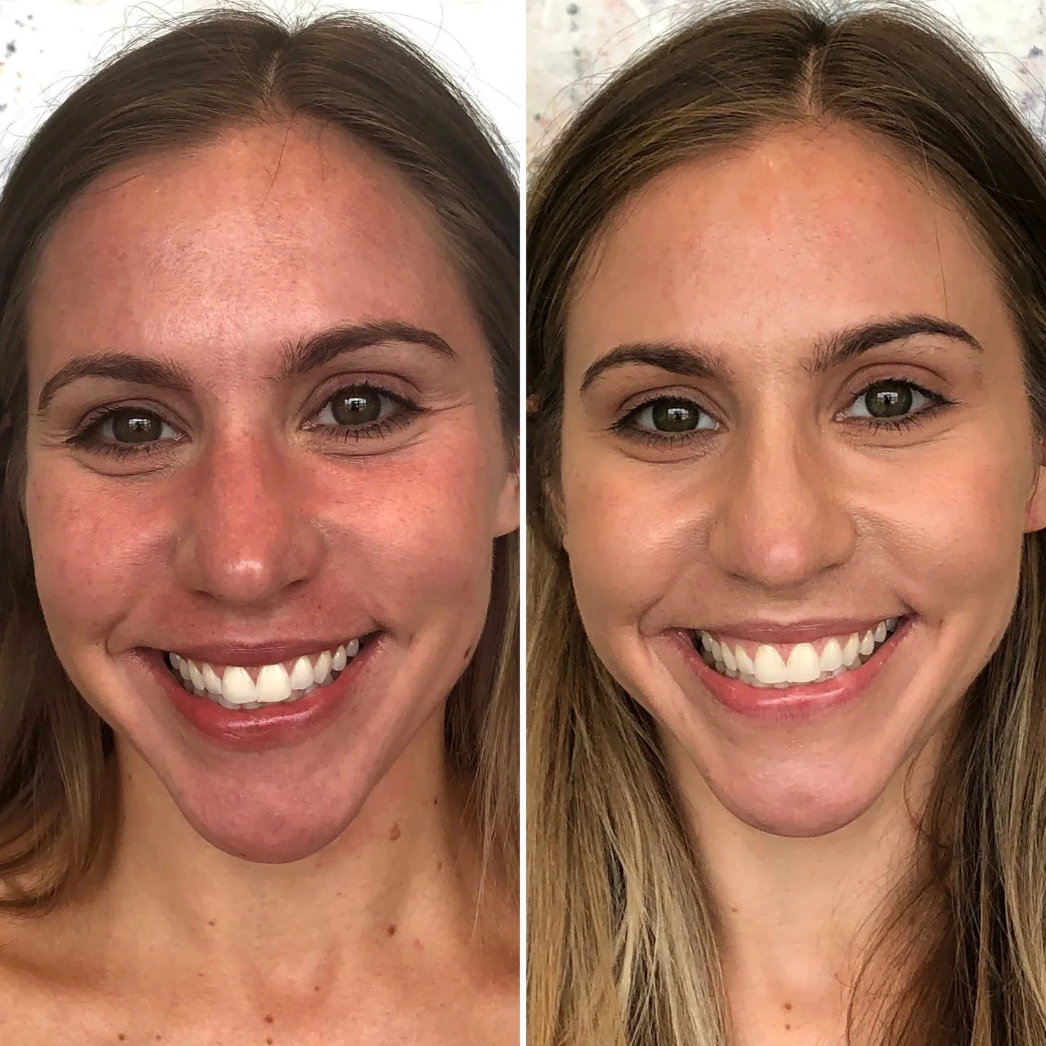 Hydra Facial