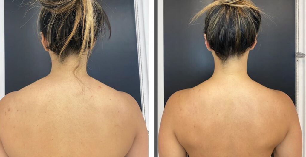 Hydra Facial