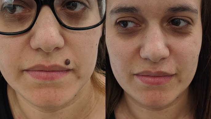 Hydra Facial