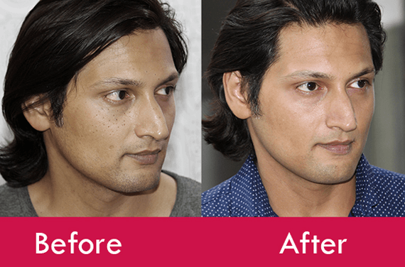 Hydra Facial